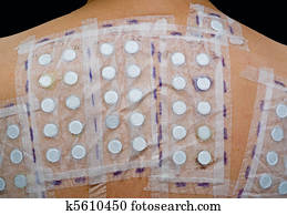 pele, alergia, teste