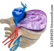 Spinal cord under pressure of bulging disc Spinal cord under pressure of bulging disc