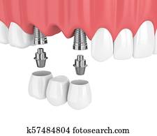 3d render of implants with dental bridge in upper jaw 3d render of implants with dental bridge in upper jaw