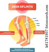 القصبة, الجبائر, سهم التوجيه, illustration., دعامة, شق طريقه عنوة, الرياضة, رض, أيضا, درس بإجهاد, pain.