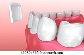 Dental Veneers: Porcelain Veneer installation Procedure. 3D illustration Dental Veneers: Porcelain Veneer installation Procedure. 3D illustration