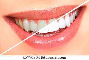 Teeth whitening Teeth whitening