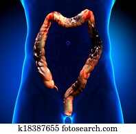 Colorectal cancer and Polyp Colorectal cancer and Polyp