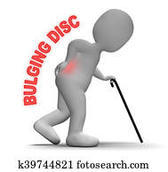 Bulging Disc Shows Back Chiropractor 3d Rendering Bulging Disc Shows Back Chiropractor 3d Rendering