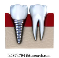 Dental implant - implanted in jaw Dental implant - implanted in jaw