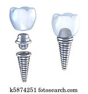 של השיניים, השרש, 3d, הכתר, עם, הדק