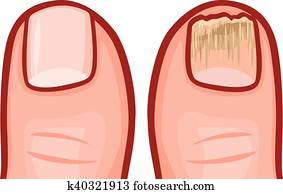 fungal, זהום, של, ה, ציפורניים