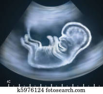 Ultrasound image of baby in womb Ultrasound image of baby in womb