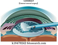 Cataract Cataract