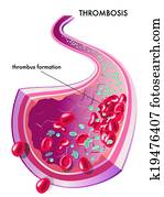 thrombosis
