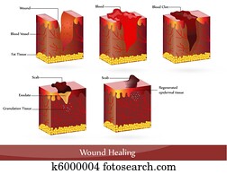 Wound healing Wound healing