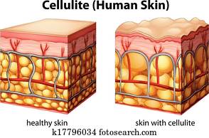 Cellulite Cellulite