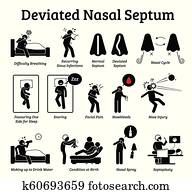 abgewichen, nasal, septum, icons. abgewichen, nasal, septum, icons.