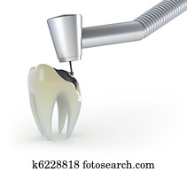 Treatment of a tooth with caries Treatment of a tooth with caries