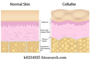 Cellulite versus smooth skin Cellulite versus smooth skin