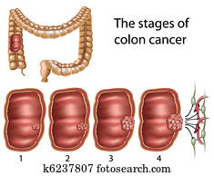 Colon cancer Colon cancer