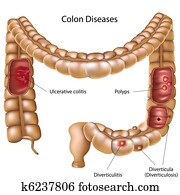 Colon pathologies Colon pathologies