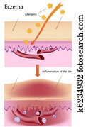 Eczema Eczema