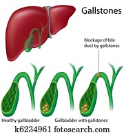 Gallstones Gallstones