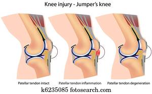 Jumper's, joelho, anatomia