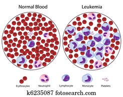 Leukemic versus normal blood Leukemic versus normal blood
