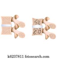 Lumbar spine osteoporosis Lumbar spine osteoporosis