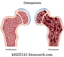 osteoporose osteoporose