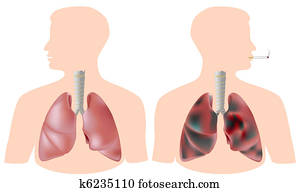 smoker's, vs., gesund, lunge smoker's, vs., gesund, lunge