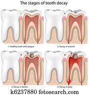 Tooth decay Tooth decay