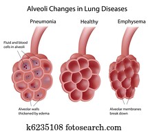 אלואולי, ב, ריאה, מחלות