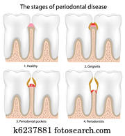 מחלה של פאריודונטאל