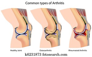 שכיח, סוגים, של, דלקת המפרקים