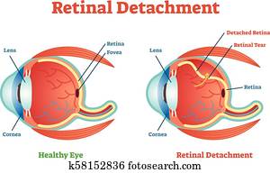 retinal, תלישות, וקטור, דוגמה, diagram,, אנטומי, scheme.