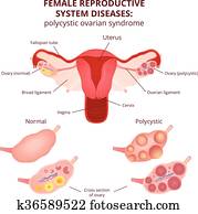 Normal Ovary Clipart | k14738541 | Fotosearch