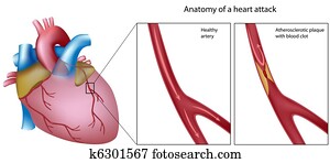 Anatomy of heart attack Anatomy of heart attack