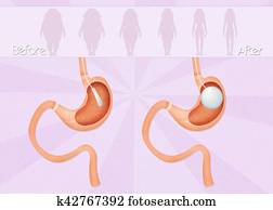 intragastric balloon surgery intragastric balloon surgery
