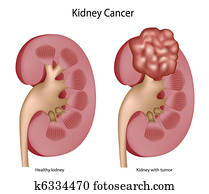 Kidney cancer Kidney cancer