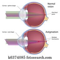 astigmatism,, eps10