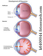 glaucoma,, eps8
