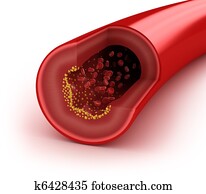 Cholesterol plaque in artery Cholesterol plaque in artery