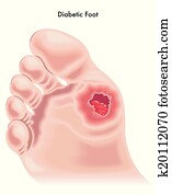 diabético, pé