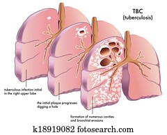 tuberculosis tuberculosis