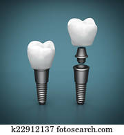 Dental implants Dental implants