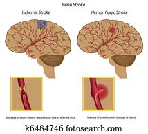 gehirn, stroke, gehirn, stroke,