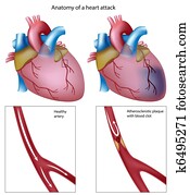 ataque cardíaco, eps8