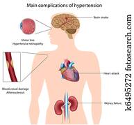 complications, של, hypertension,, eps8