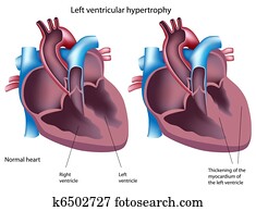 Left ventricular hypertrophy, eps8 Left ventricular hypertrophy, eps8