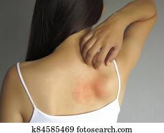 Health allergy skin care problem. Closeup young woman scratching her itchy back with allergy rash Health allergy skin care problem. Closeup young woman scratching her itchy back with allergy rash