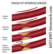 Atherosclerosis, eps8 Atherosclerosis, eps8