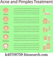 tipos, de, acné, granos, piel humana, cartel, vario, cosméticos
